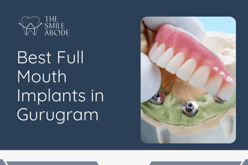 Full mouth implants