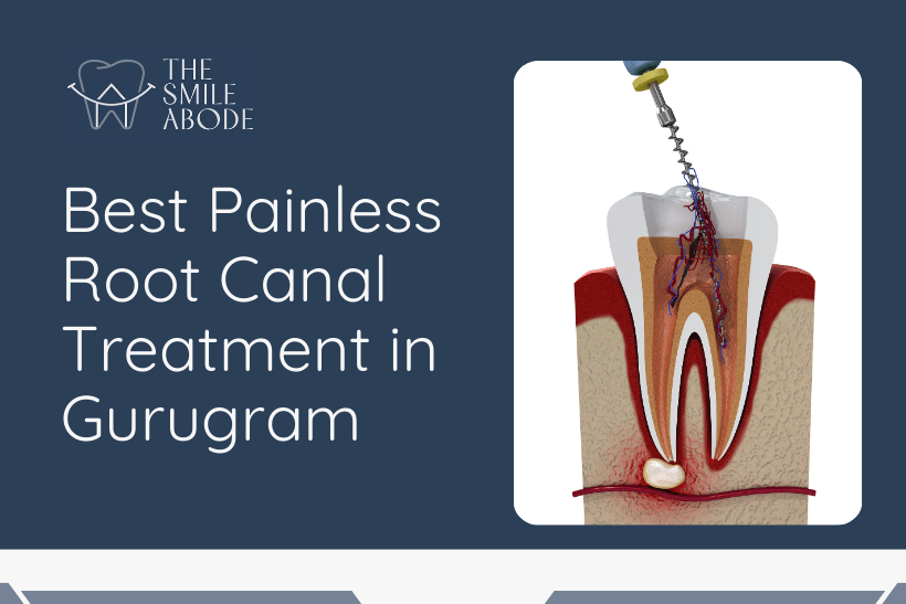 root canal treatment