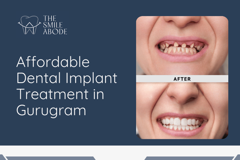 Dental Implants in Gurugram
