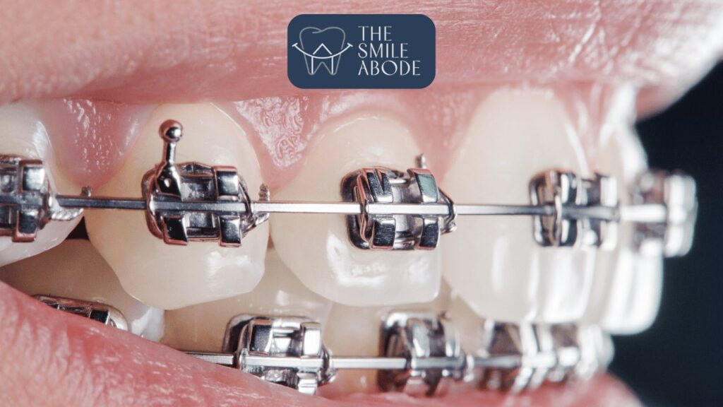 Best Braces Treatment in Gurugram Sector 47