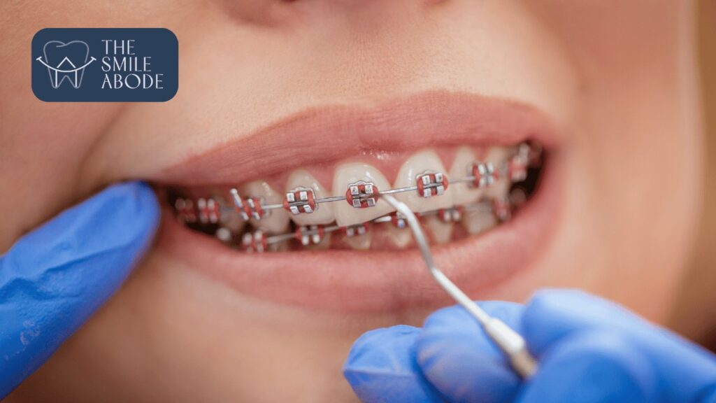 Best Braces Treatment in Gurugram Sector 47