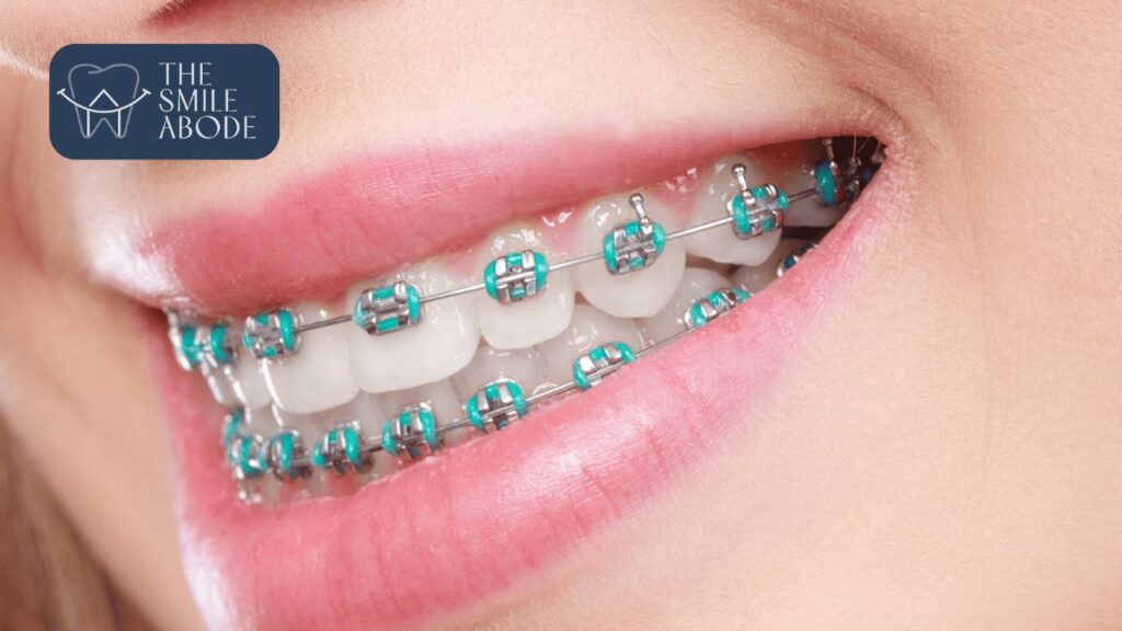 Best Braces Treatment in Gurugram Sector 47