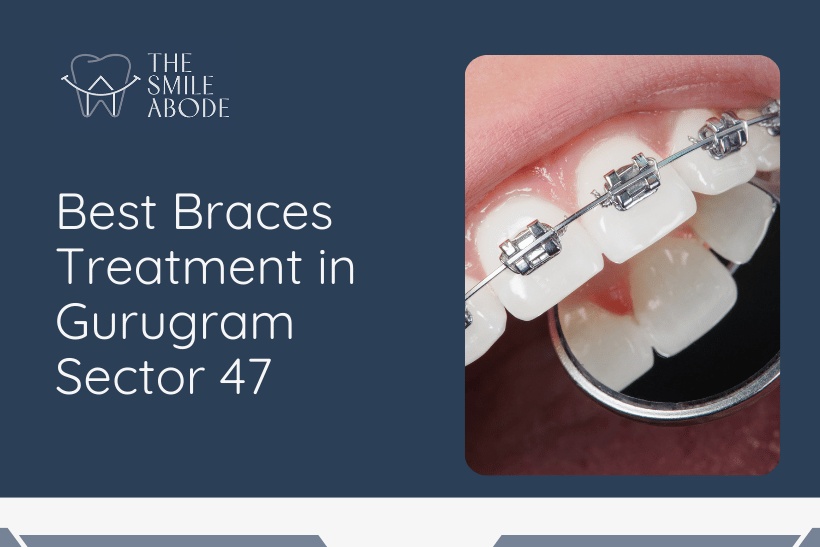 Braces Treatment in Gurugram
