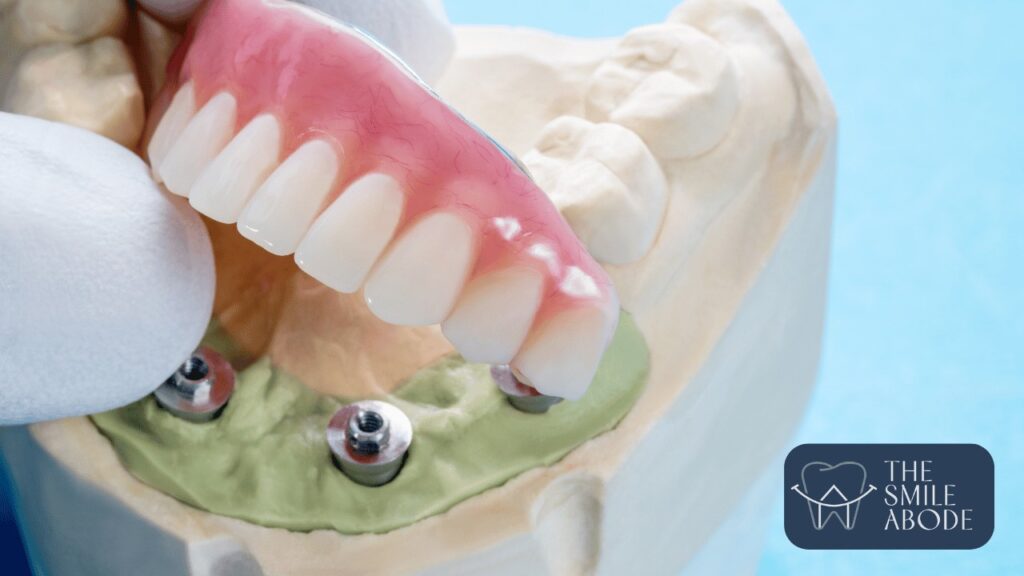 Best Full Mouth Implants in Gurugram Sector 48