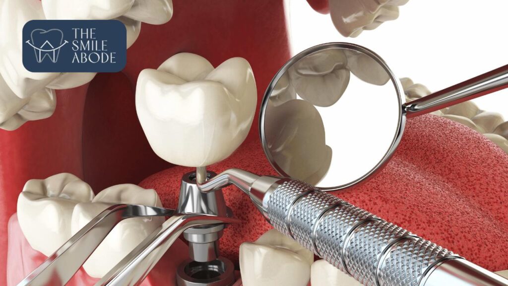 Best Full Mouth Implants in Gurugram Sector 48