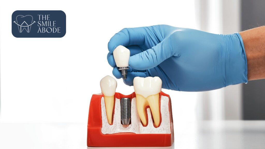 Best Full Mouth Implants in Gurugram Sector 48