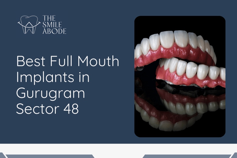 Full mouth implants in Gurugram