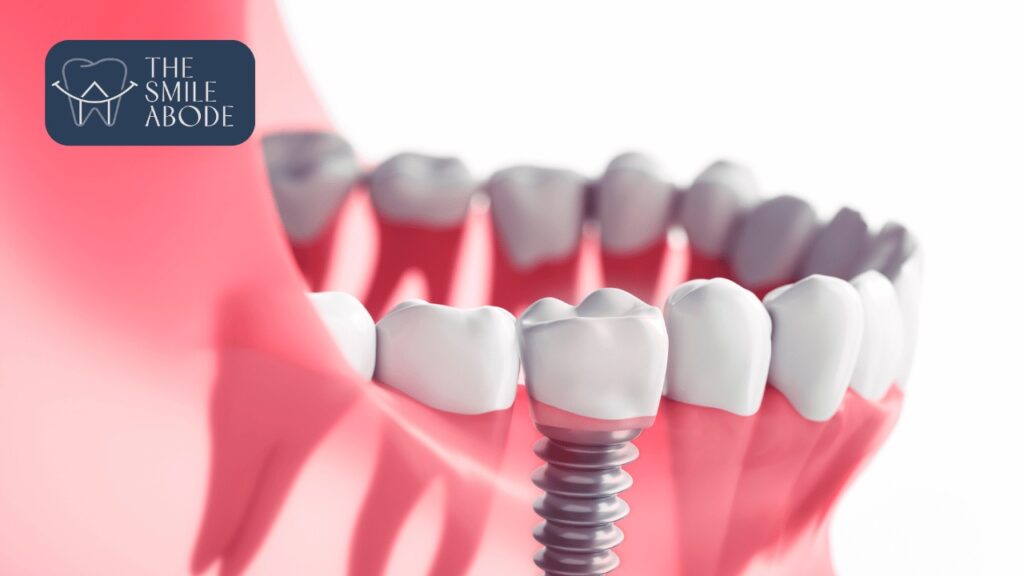 Top Dental Implants in Gurugram Sector 50