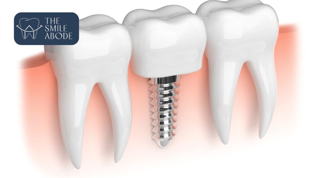 Top Dental Implants in Gurugram Sector 50