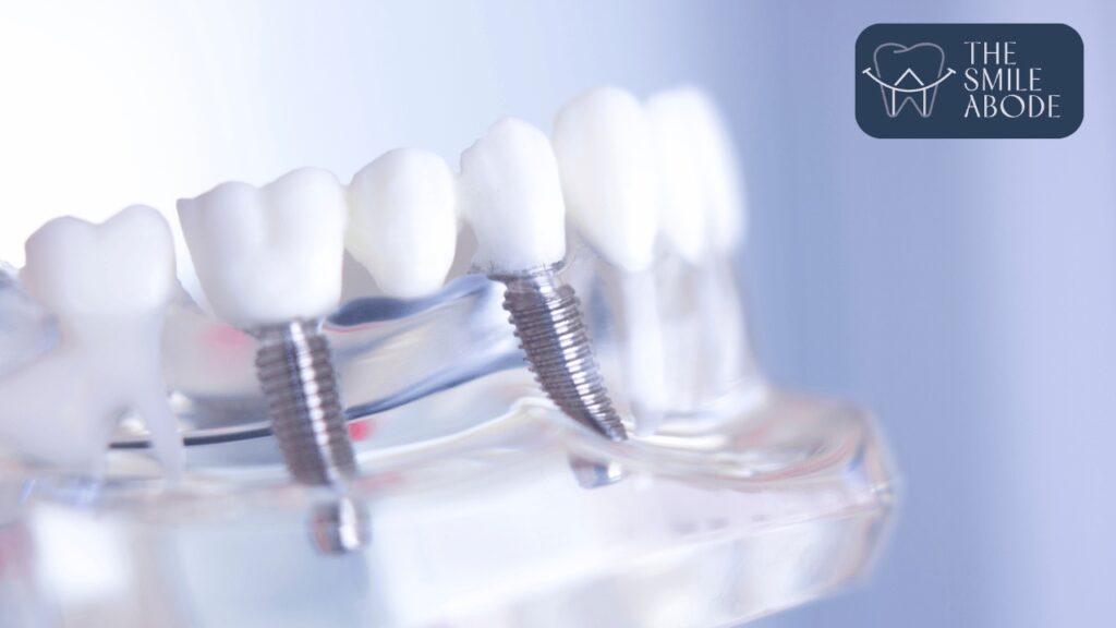 Top Dental Implants in Gurugram Sector 50