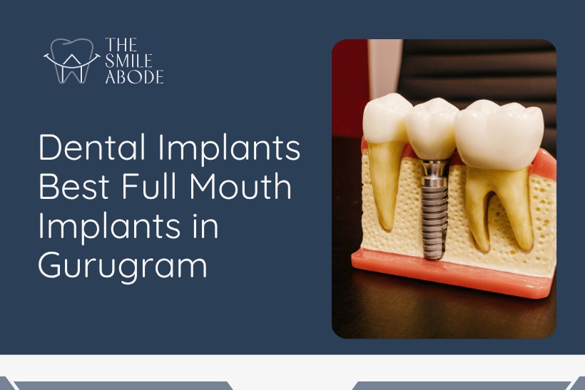 Full mouth implants in Gurugram