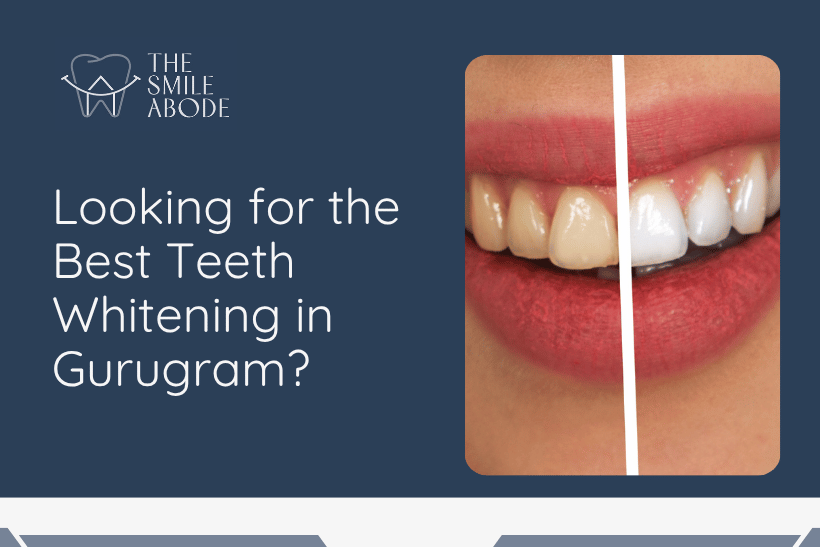 Best Teeth Whitening in Gurugram