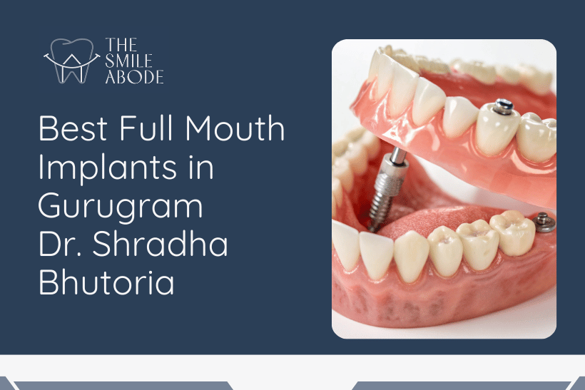 Full mouth implants in Gurugram