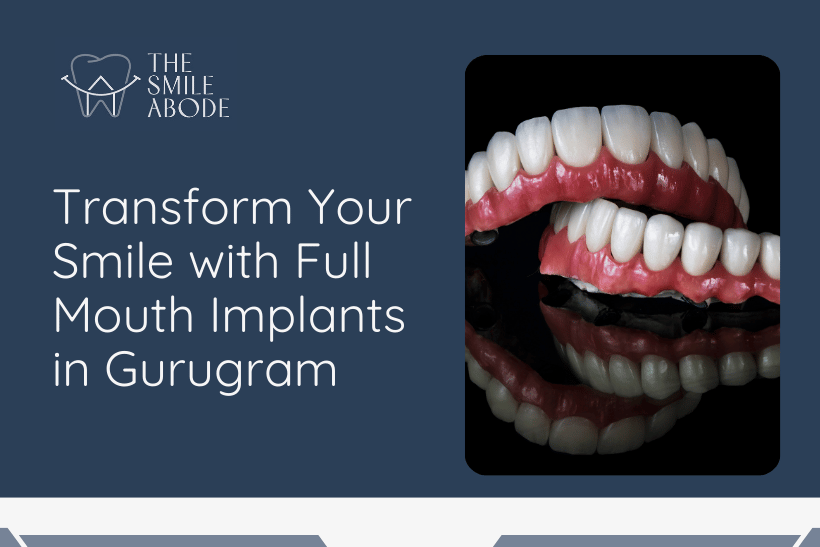 Full mouth implants in Gurugram
