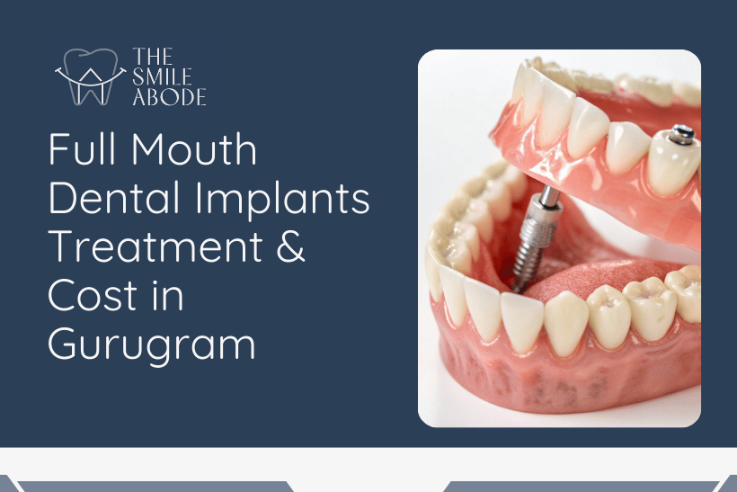 Best ⁠Full Mouth Implants in Gurugram