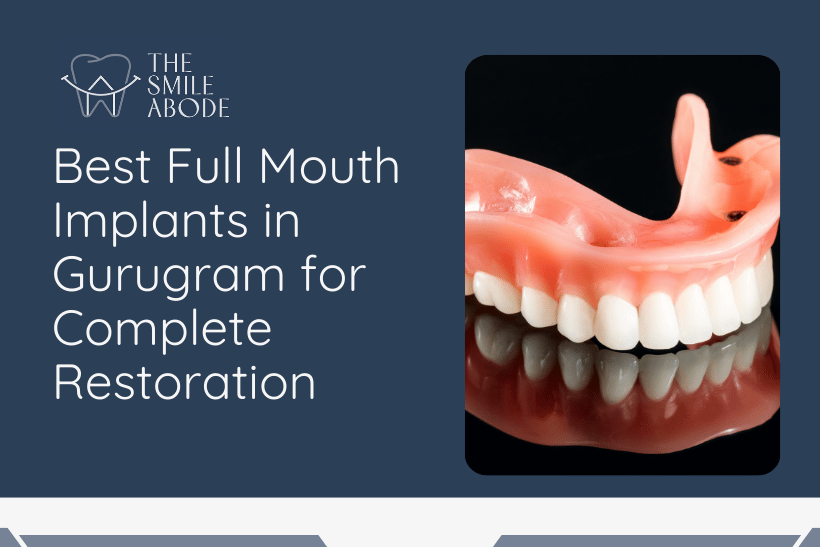 Best Full Mouth Implants in Gurugram