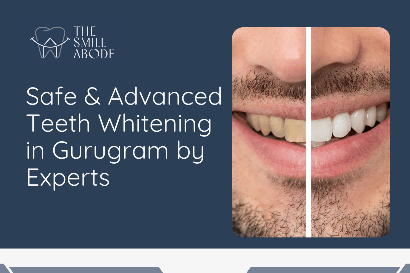 Best Teeth Whitening in Gurugram