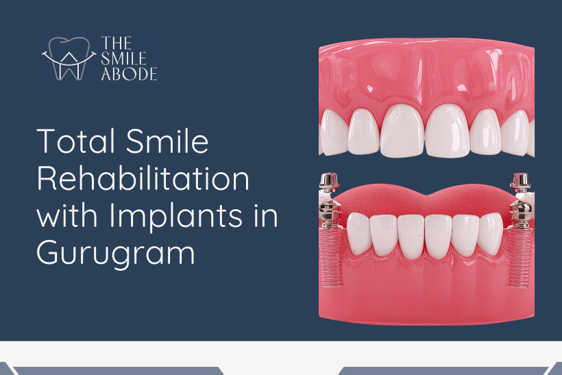 full mouth implants near me in gurugram