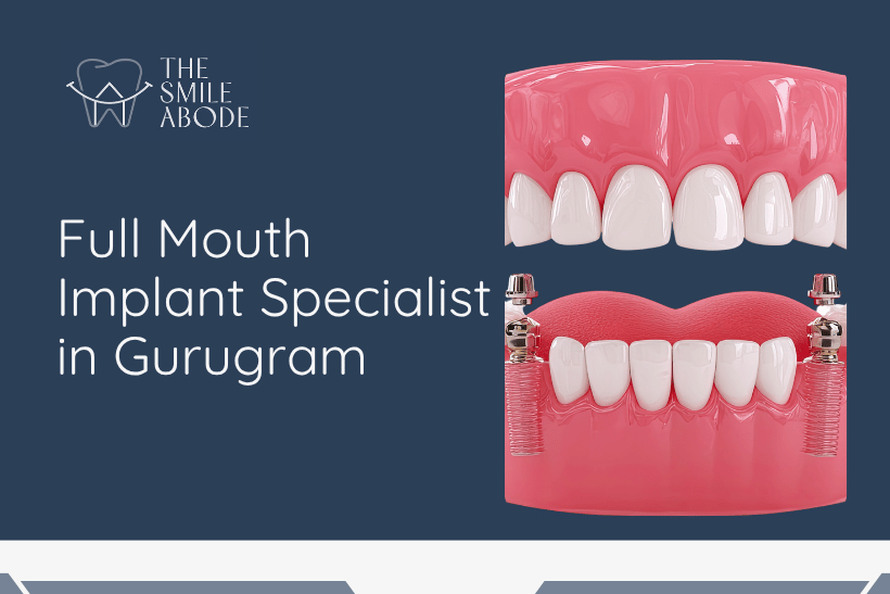 Best Full Mouth Implants in Gurugram