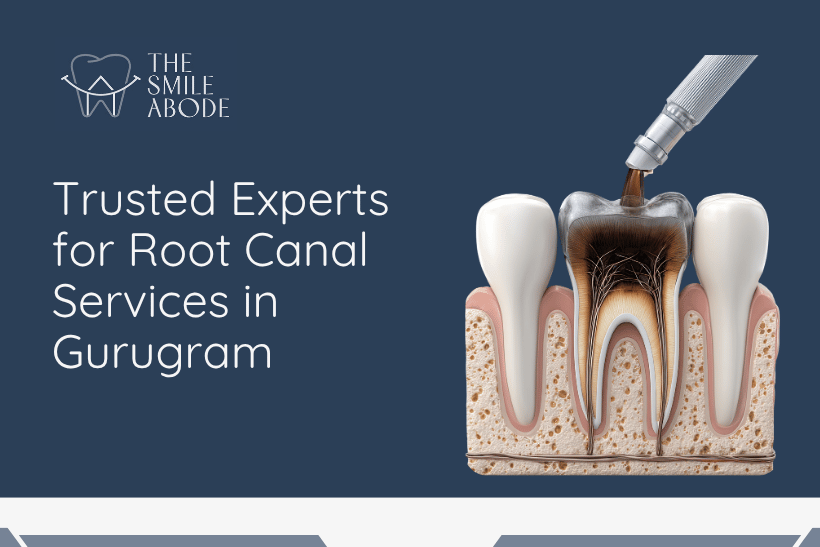 Root Canal Services in Gurugram