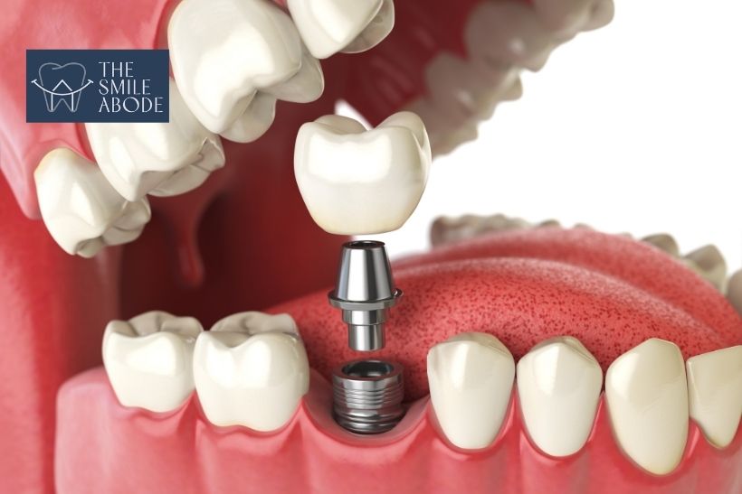 Full mouth implant planning at a dental clinic in Gurugram