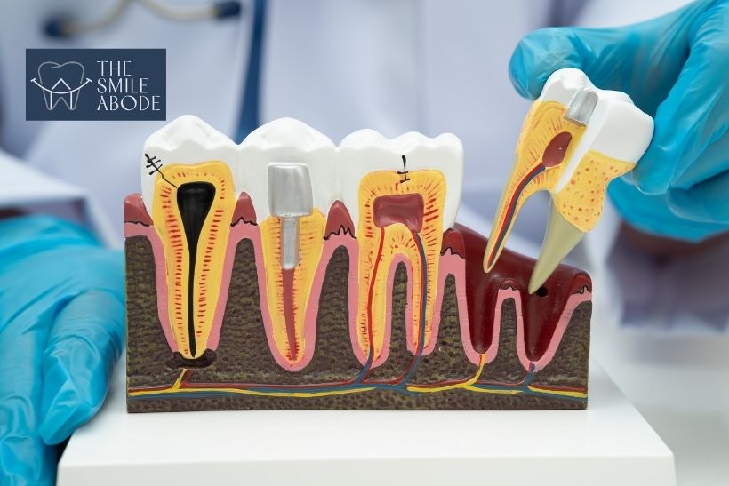 Patient consultation after root canal treatment in Gurugram