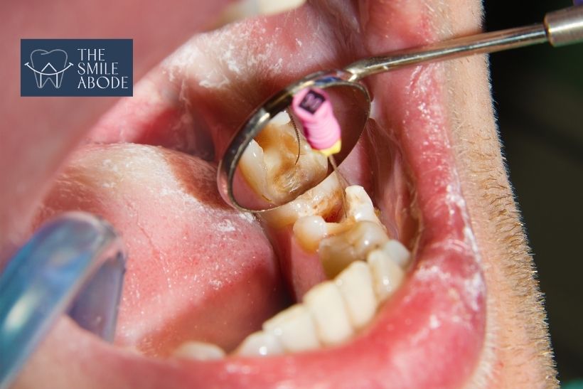 Anxious patient receiving sedation dentistry for root canal treatment in Gurugram