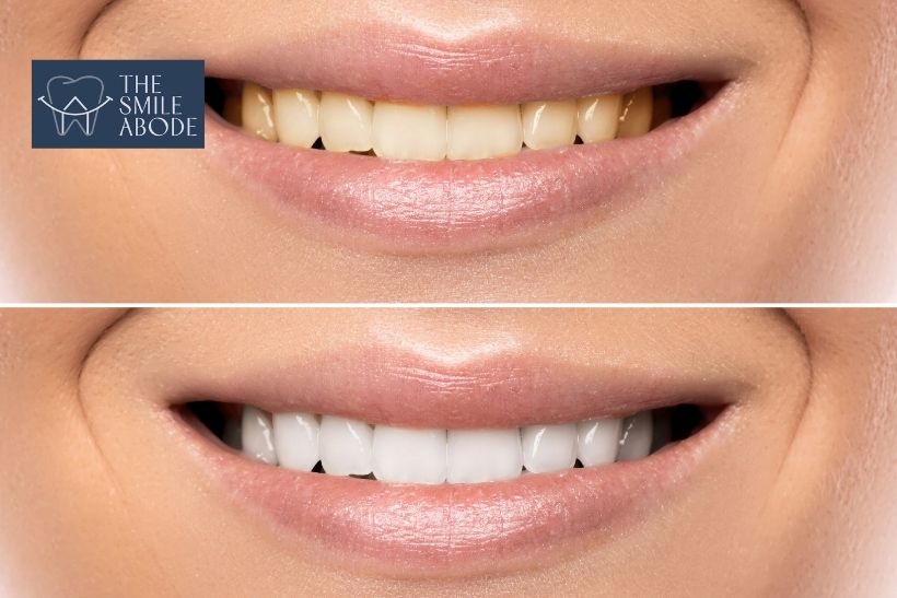 Dentist assessing tooth shade for whitening treatment at The Smile Abode, Gurugram