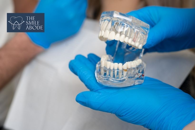 CBCT bone scan used during dental implant consultation at The Smile Abode, Gurgaon