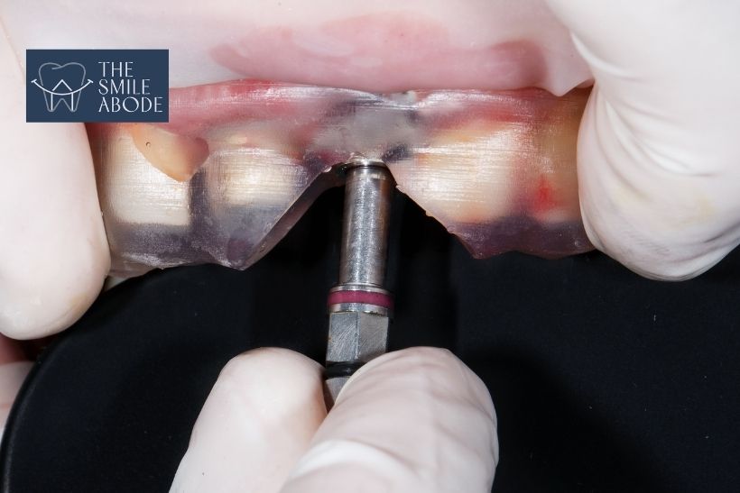Dental implant crown being fitted by a prosthodontist at The Smile Abode, Gurugram
